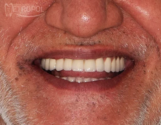 Protetik diş tedavisi