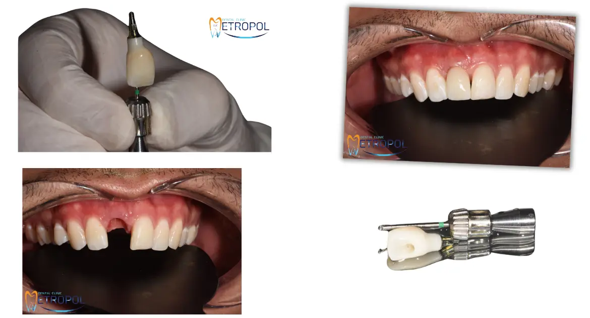 Oral Implantoloji 1
