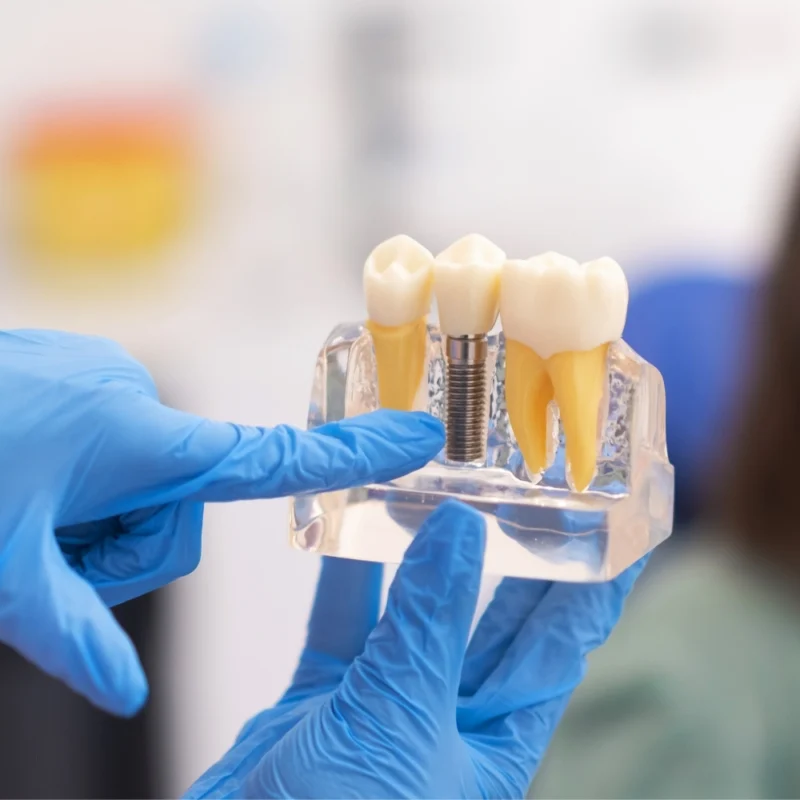 En Kaliteli Diş İmplantı